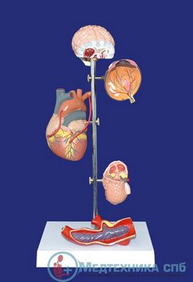 изображение: Модель “Воздействие артериальной гипертензии, 5 частей”