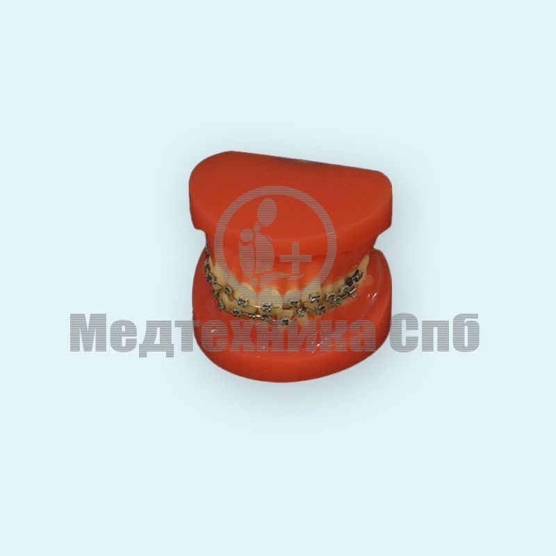 Ортодонтическая модель с корректирующим устройством (неправильный прикус)