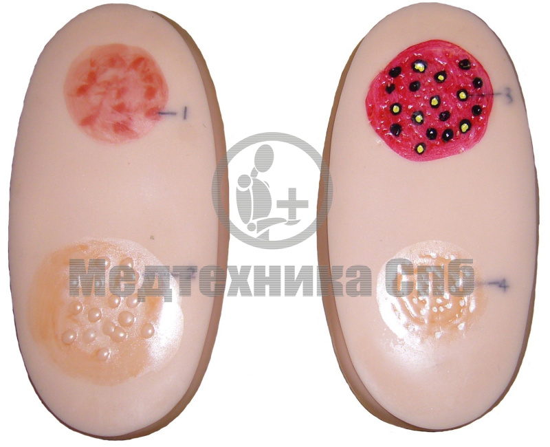 H91 Набор модулей с поражениями от оспы