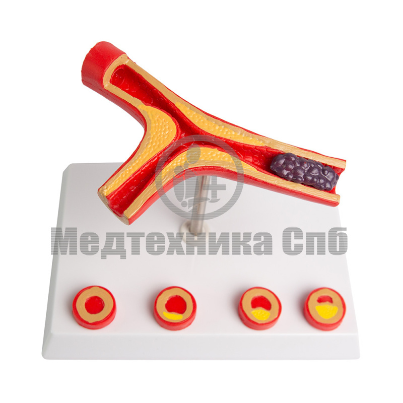 B0901 Модель патологии артерий