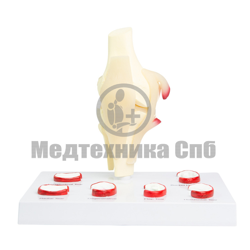 PZ1001 Модель повреждений мениска